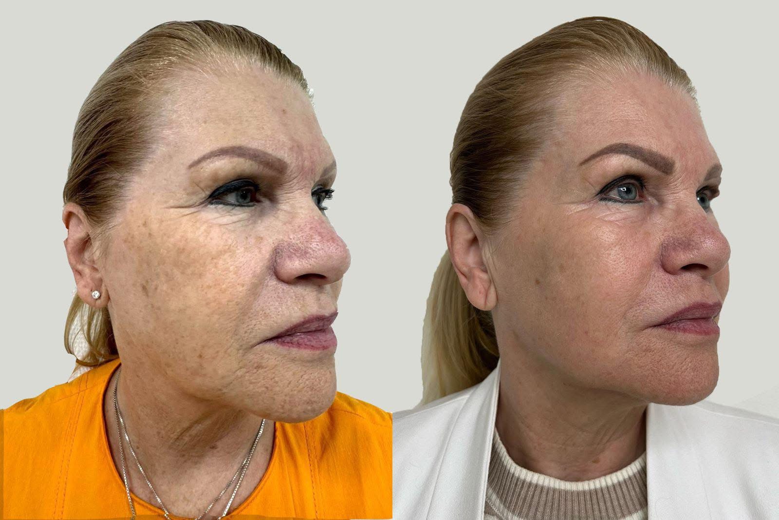 Resultaat NeoGen Plasma: vóór en na de behandeling