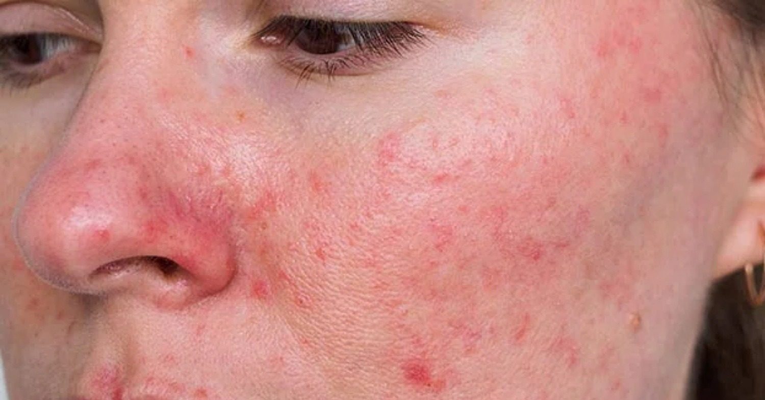 Rosacea behandelen