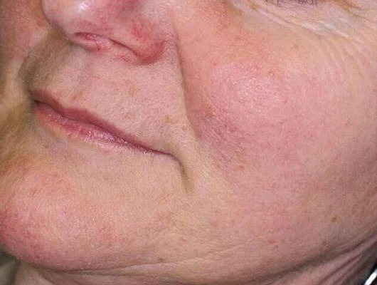 Rosacea na de behandeling