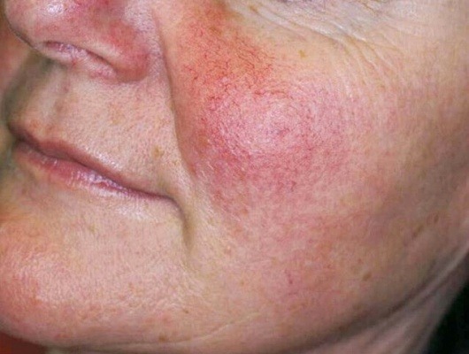 Rosacea vóór de behandeling
