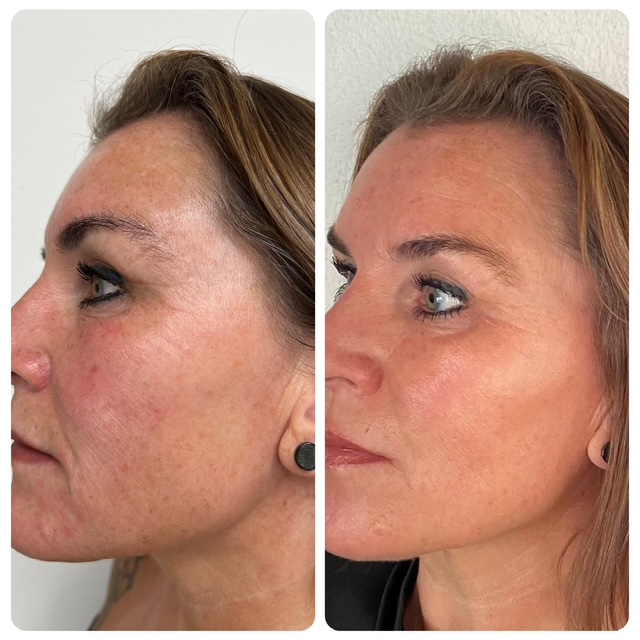 Resultaat skinbooster met zalm-DNA: vóór en na de behandeling