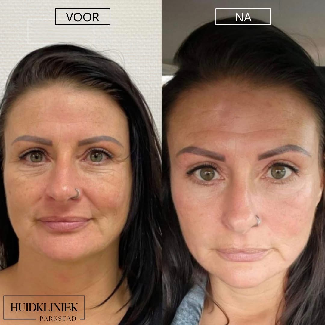 Resultaat medische peeling: vóór en na de behandeling