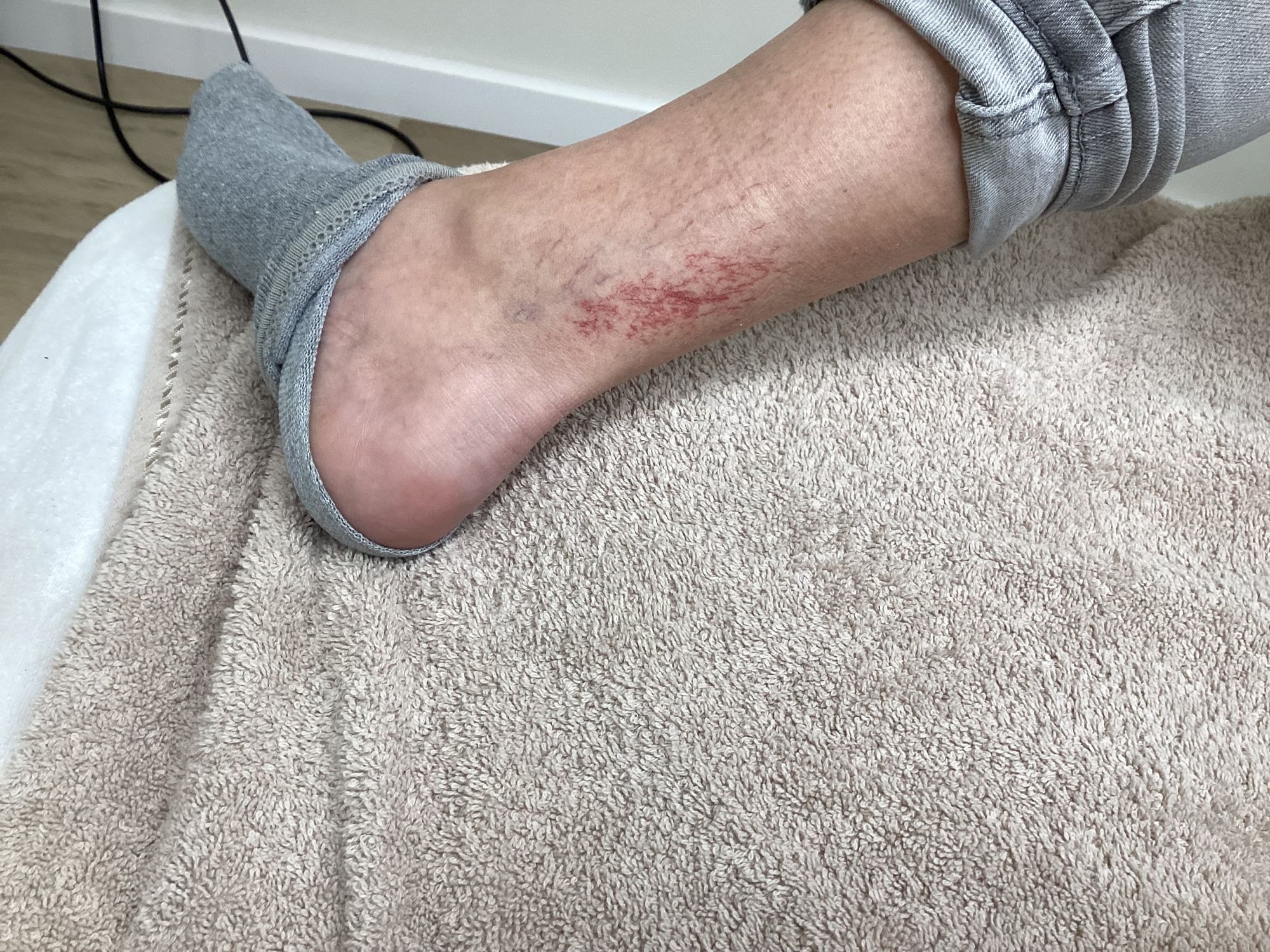 Beenvaatjes vóór de behandeling met de vaatlaser