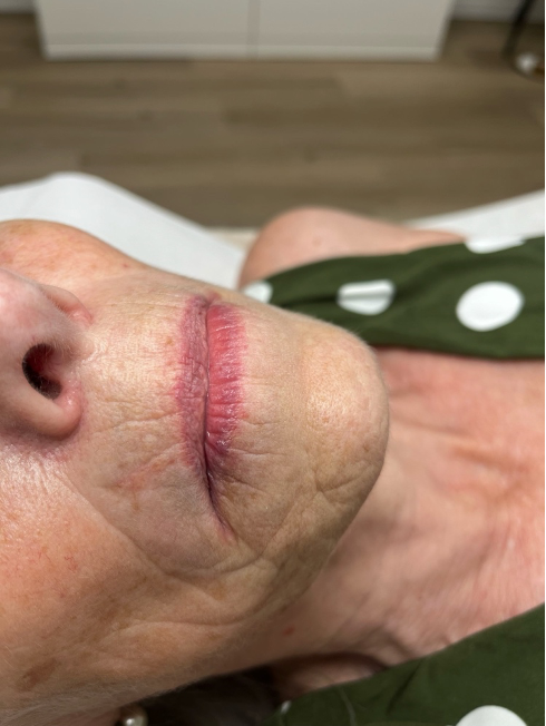 Lip na de behandeling