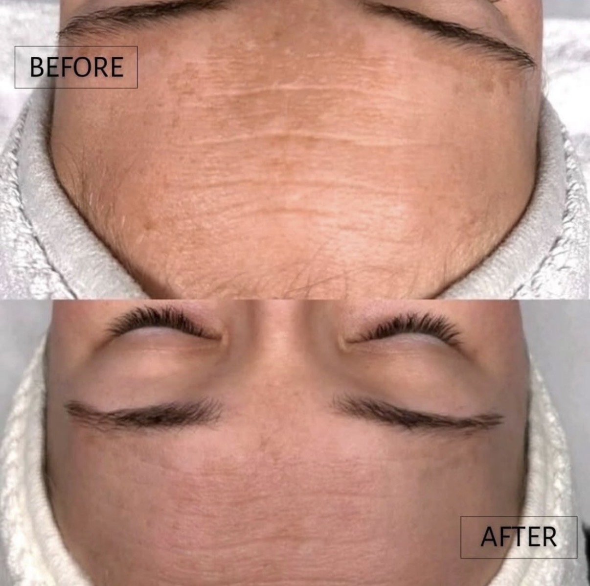 Melasma op het voorhoofd vóór en na de behandeling