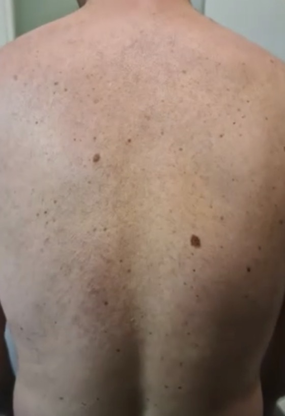 Laserontharing bij een man na de behandeling
