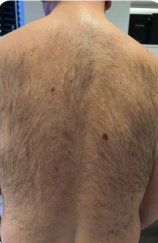 Laserontharing bij een man vóór de behandeling