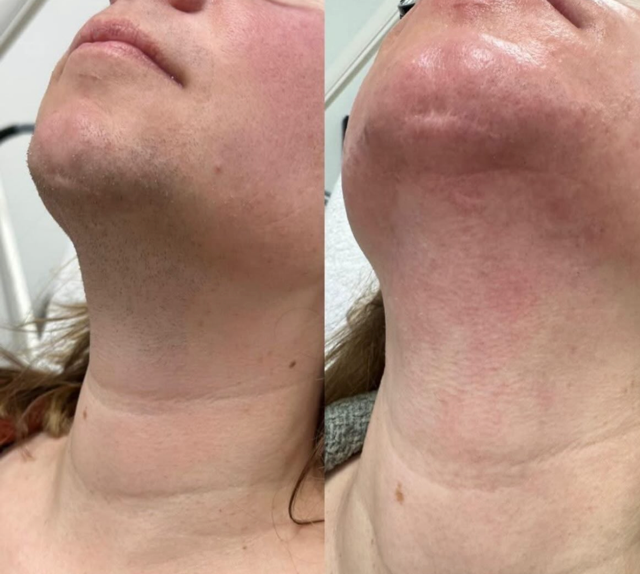 Resultaat laserontharing: vóór en na de behandeling