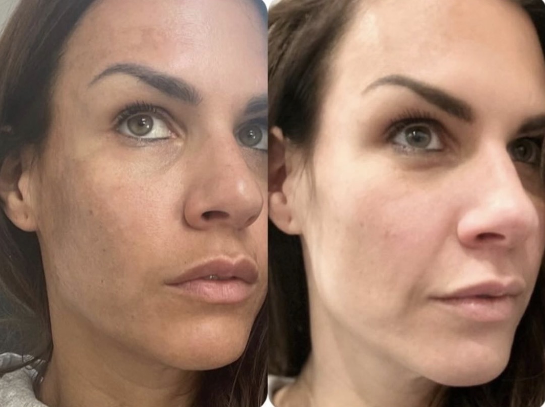 Melasma vóór en na de behandeling